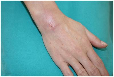 Mycobacterium chelonae hand infection following acupuncture: a case report and literature review